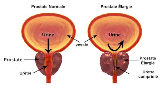 Taille prostate normale par rapport à une prostate élargie