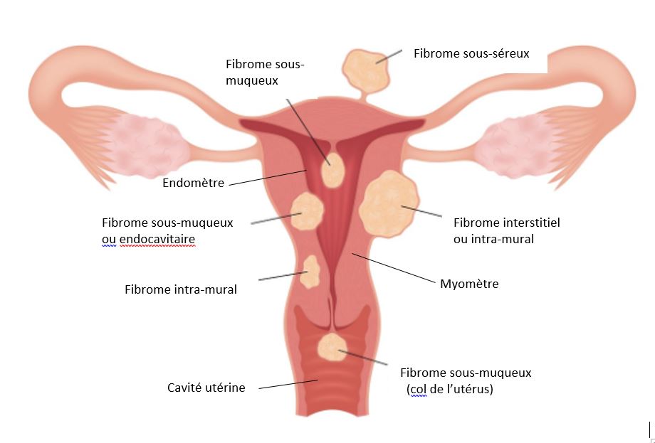 Les fibromes de l'utérus