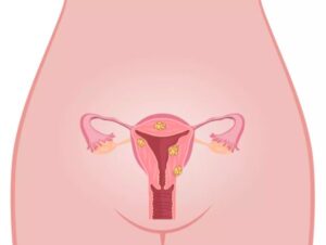 Les fibromes de l'utérus - Naturopathe la valette du var