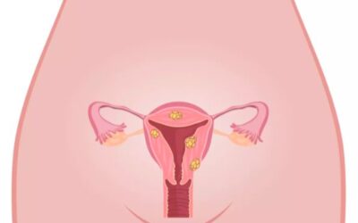 Les fibromes de l’utérus