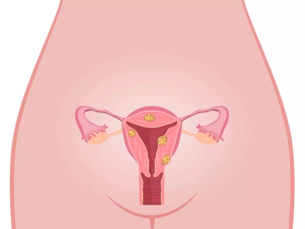 Les fibromes de l’utérus