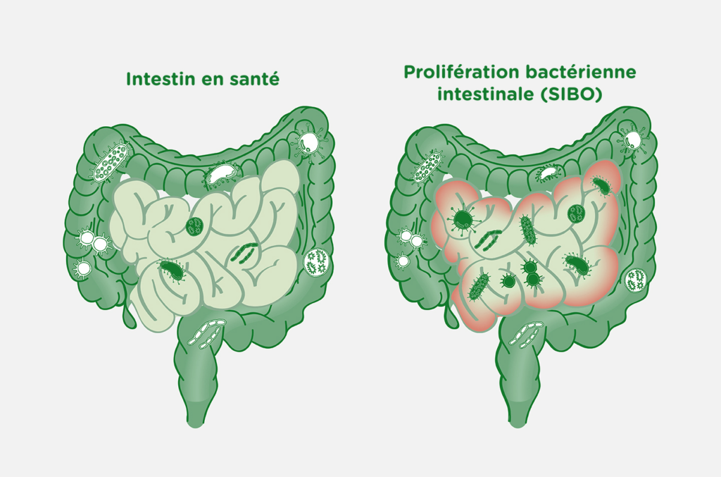 Schéma intestin en bonne santé et intestin avec prolifération bactérienne intestinale SIBO